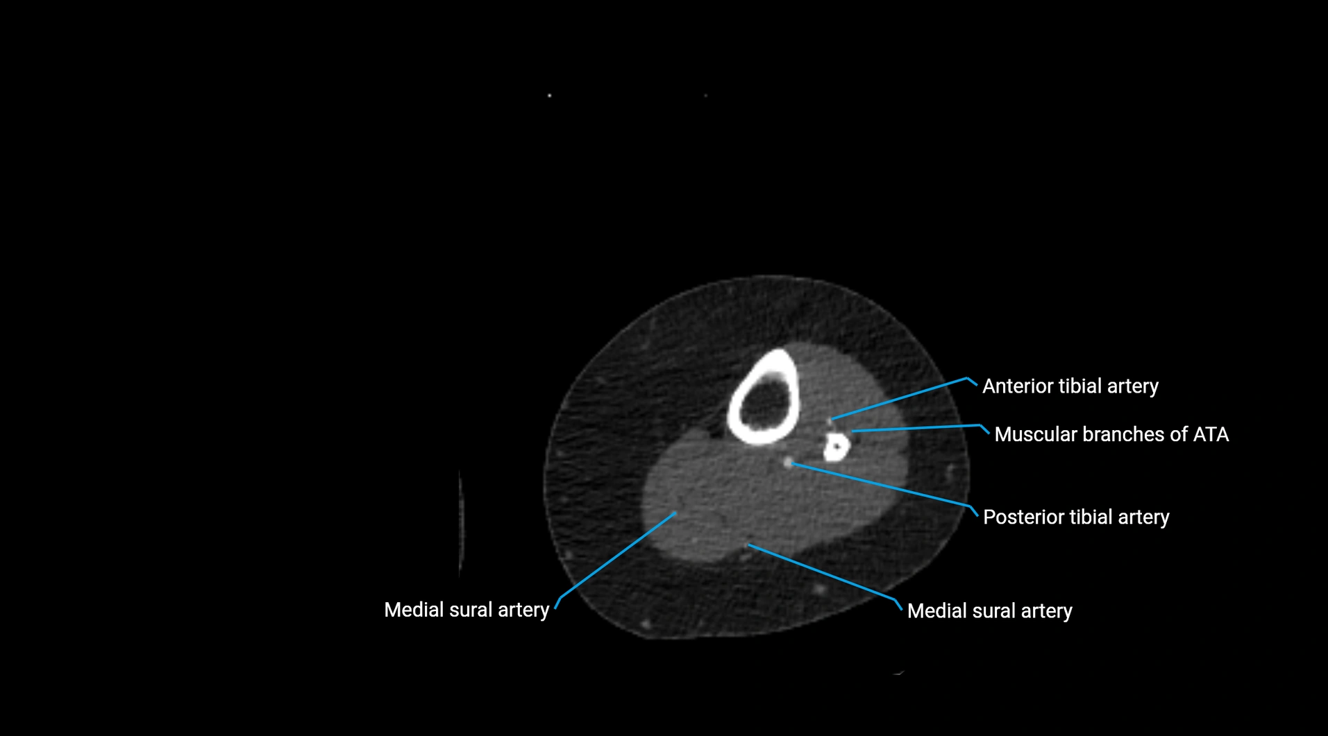 CTA lower limb cross sectional anatomy labelled image _198.webp